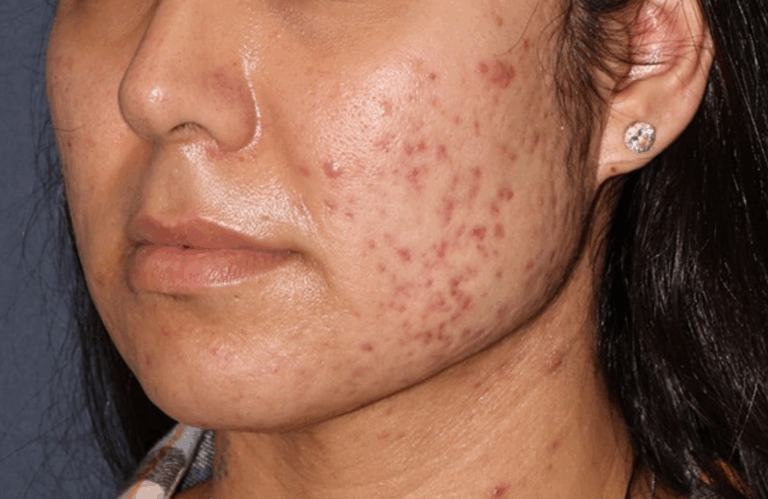Before acne scar treatment