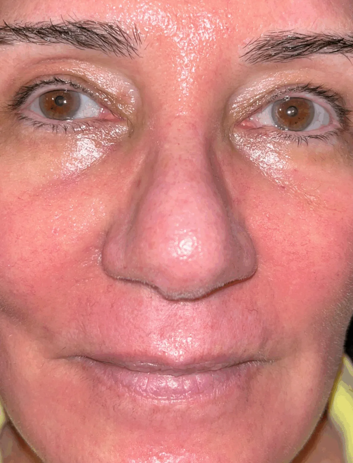 ProFractional treatment