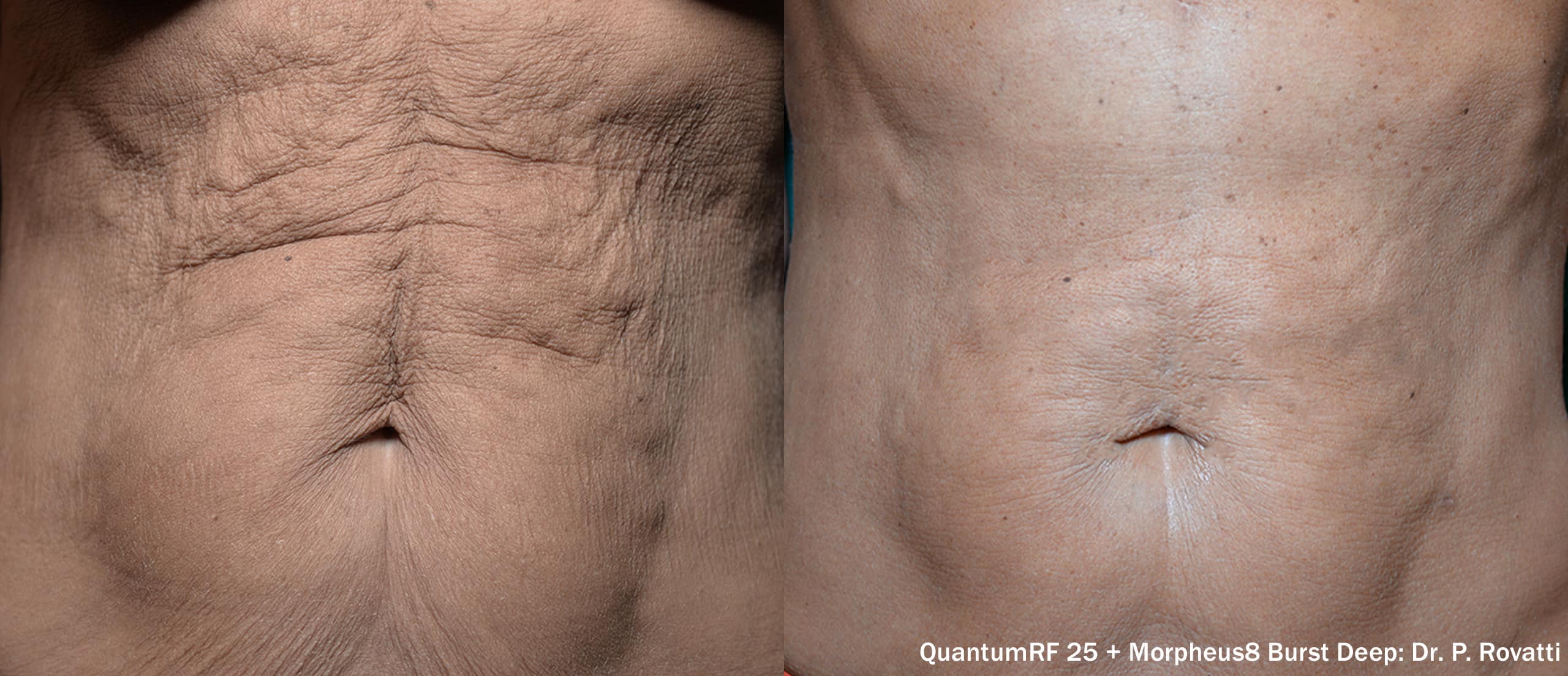 Quantum RF abdomen treatment
