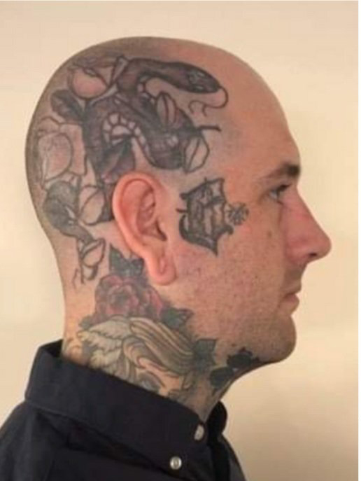 Tattoo removal before and after