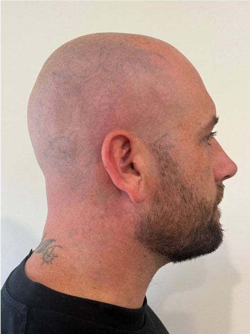 Tattoo removal before and after