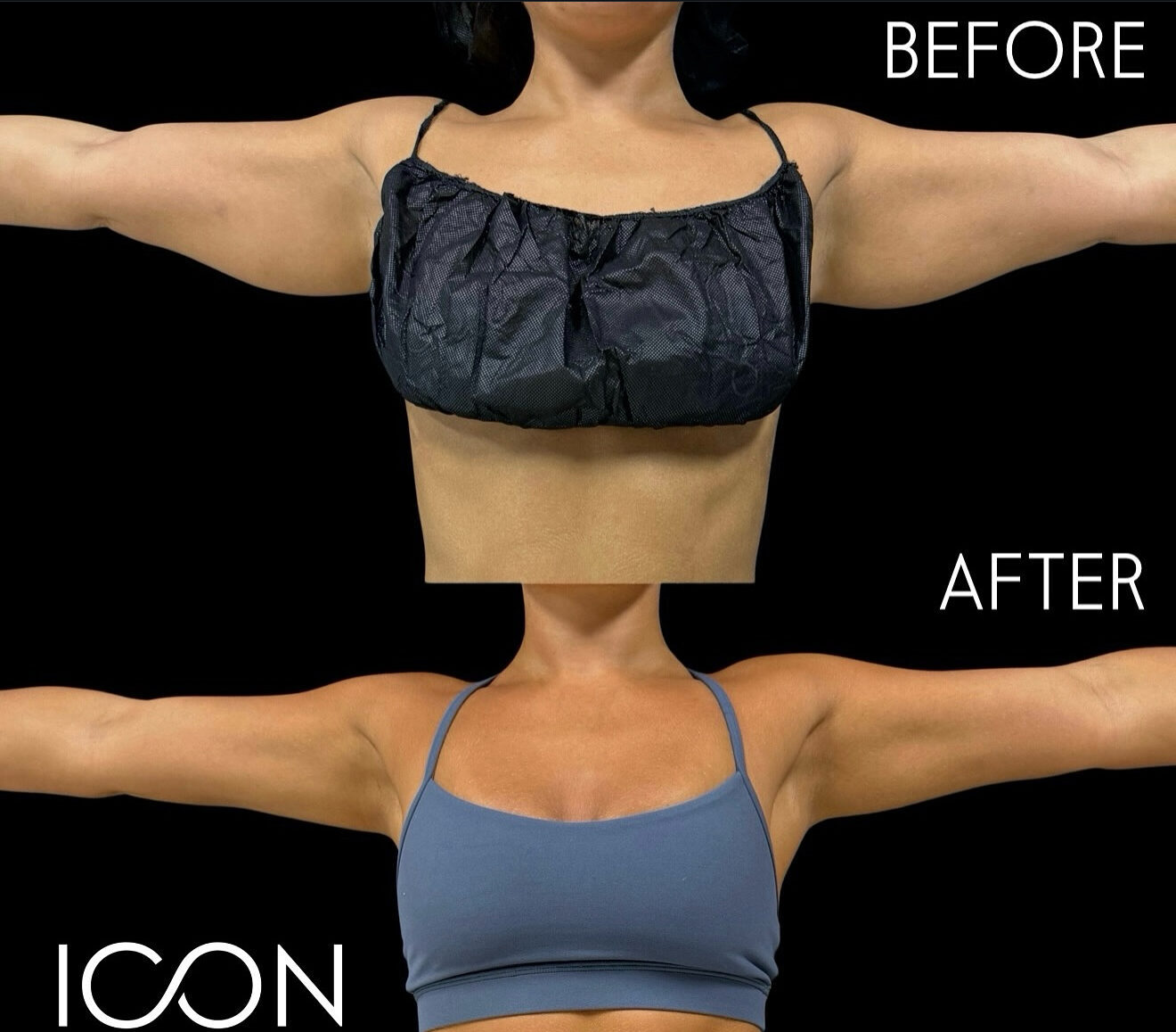 Awake liposuction healing