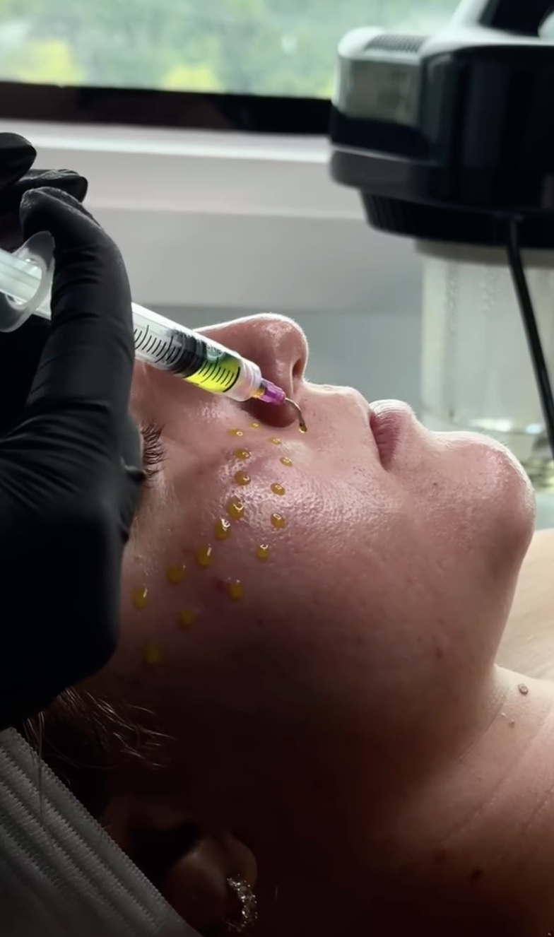 Chemical Peels