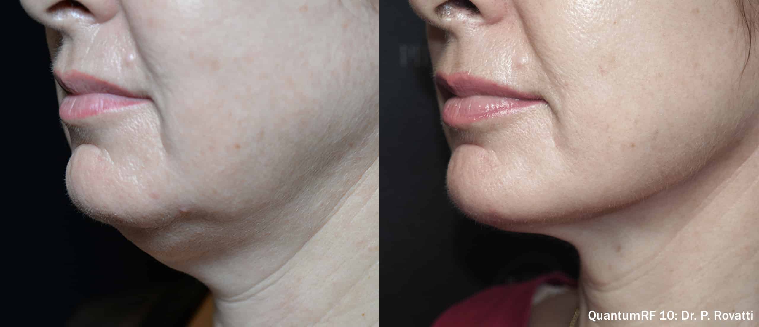 Quantum RF jowl treatment