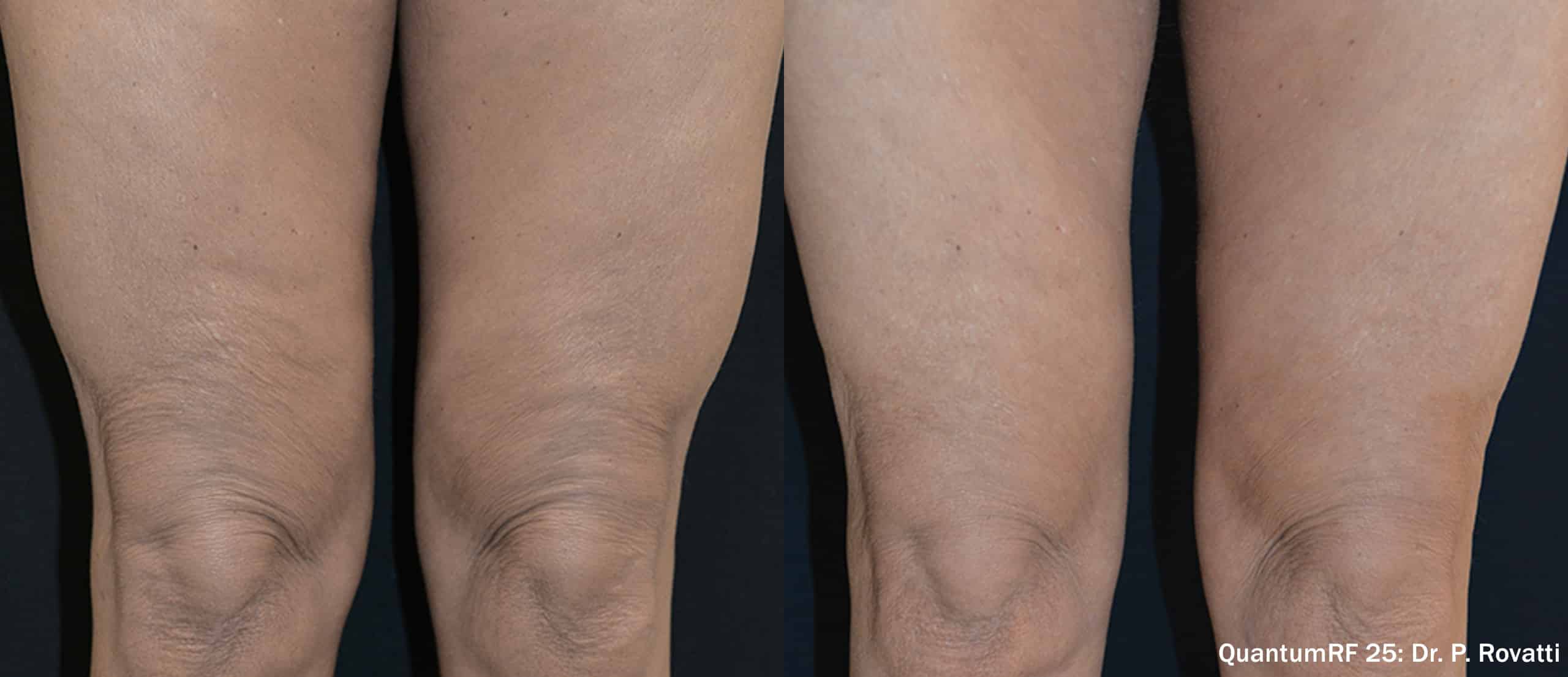 Quantum RF thighs treatment