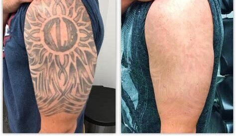 Tattoo removal result