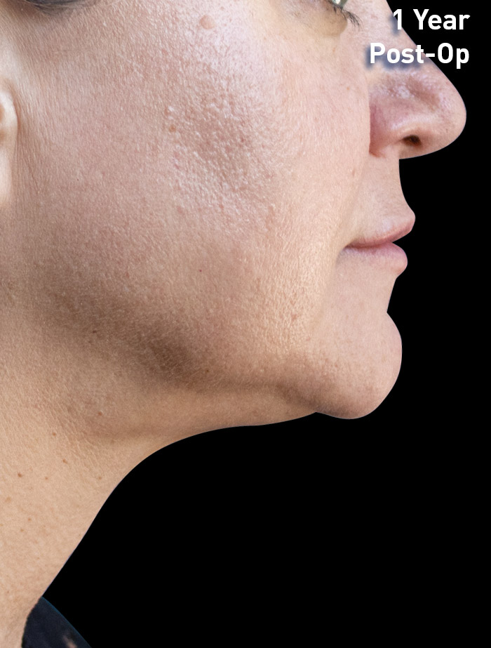 Renuvion after treatment