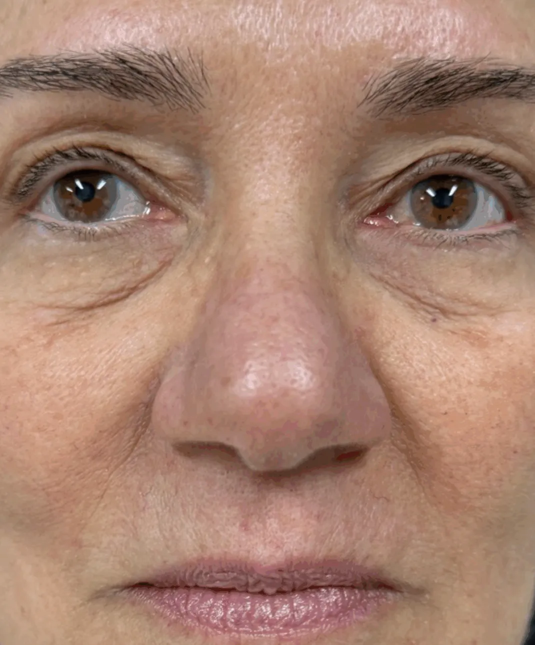 ProFractional treatment