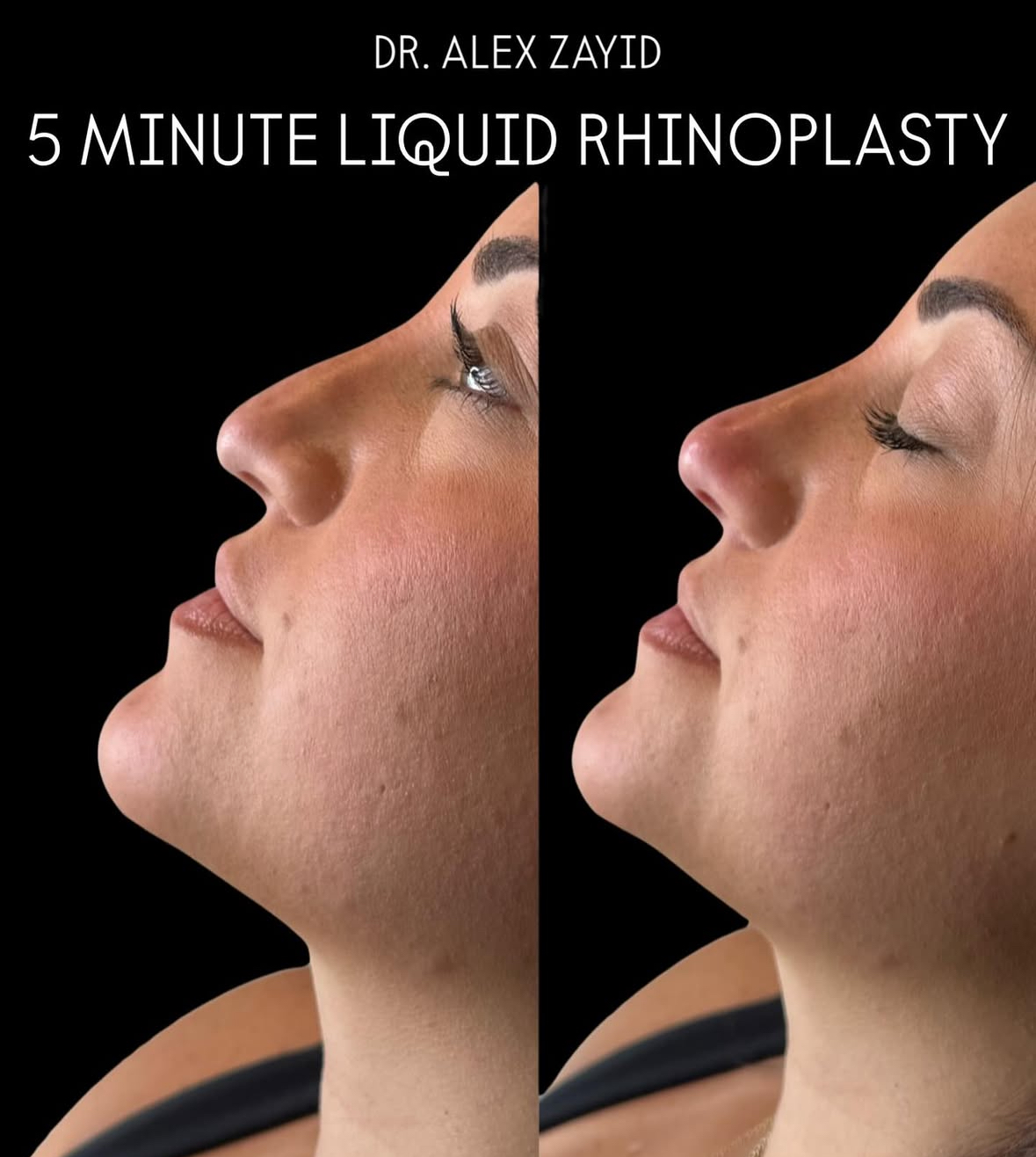 Liquid Rhinoplasty