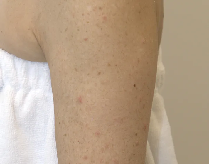 After Halo Treatment