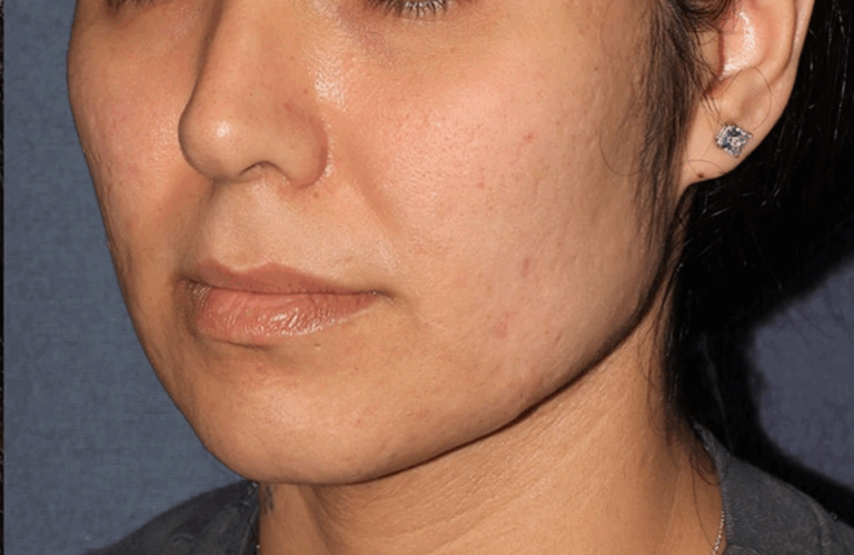 After acne scar treatment