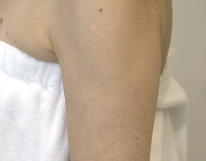Before Halo Treatment