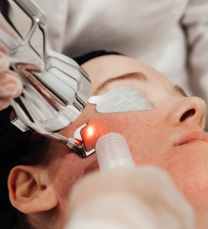ProFractional resurfacing
