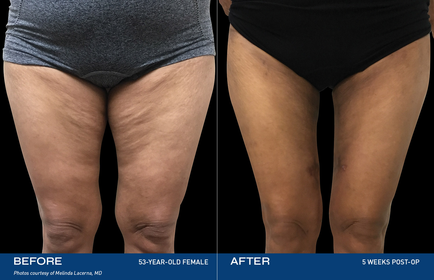 Renuvion treatment