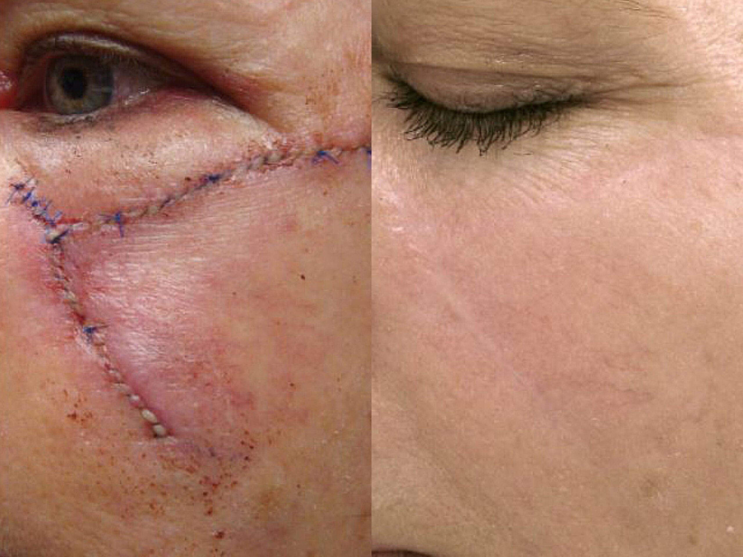 ProFractional results