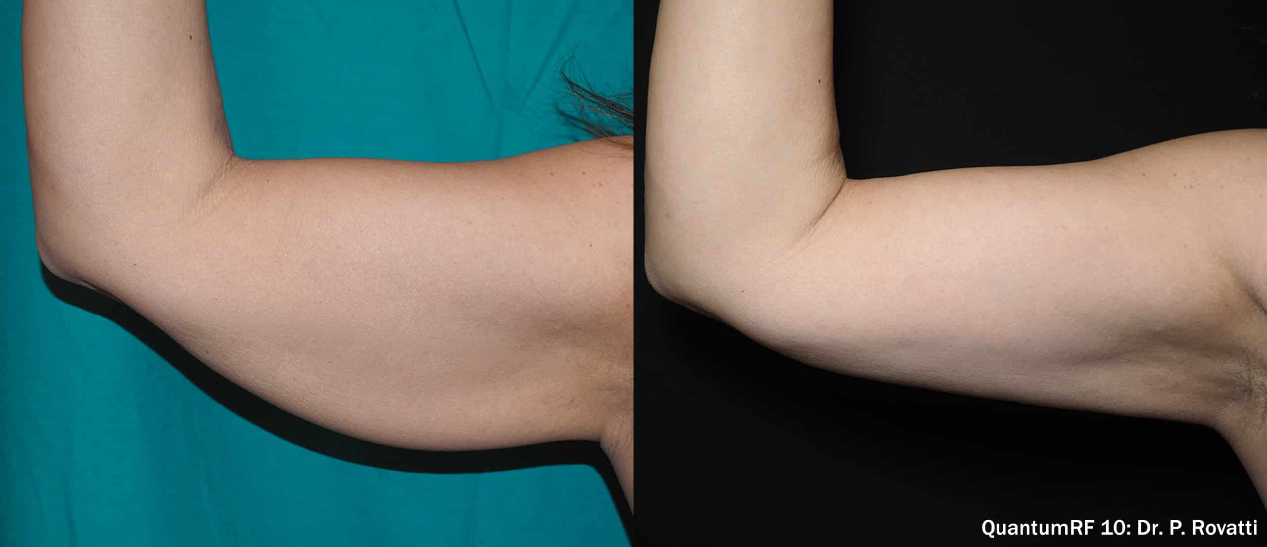 Quantum RF arm treatment