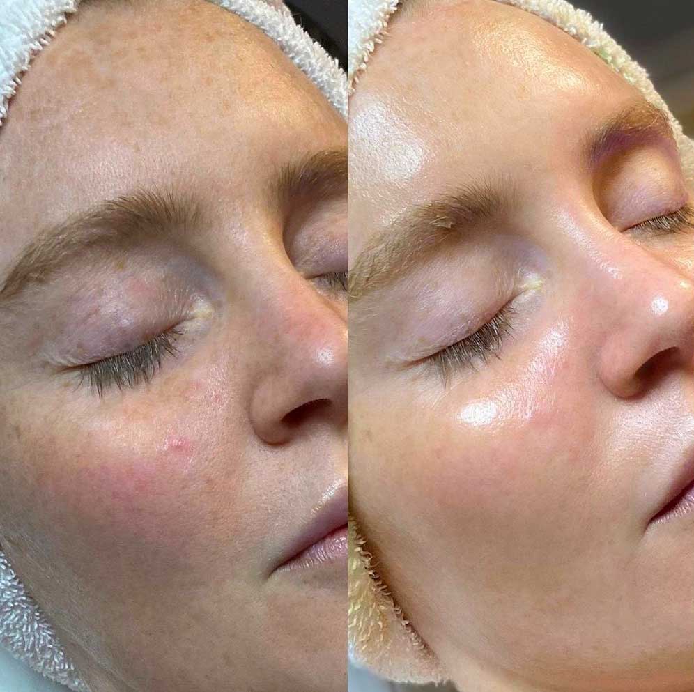 Express Hydrafacial