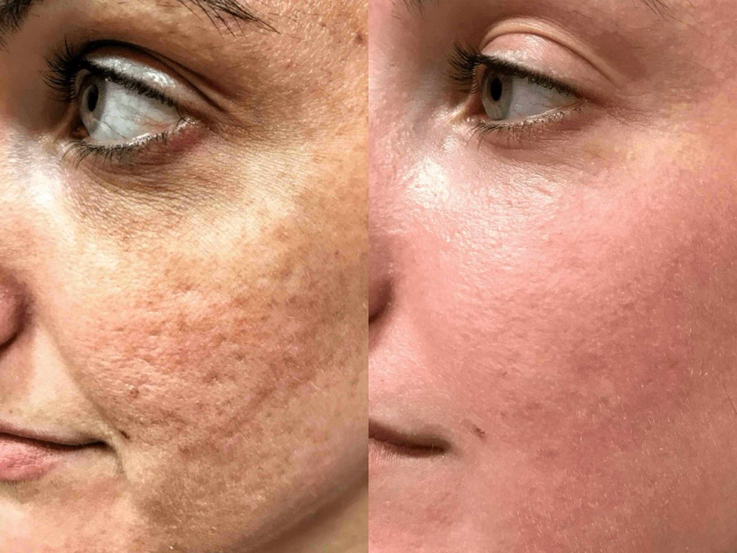 ProFractional results