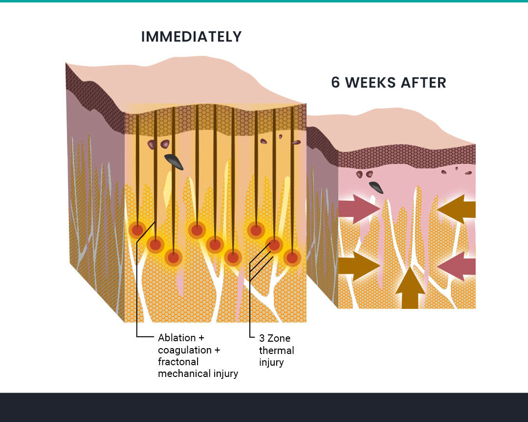 Morpheus8 Before and After Infographic