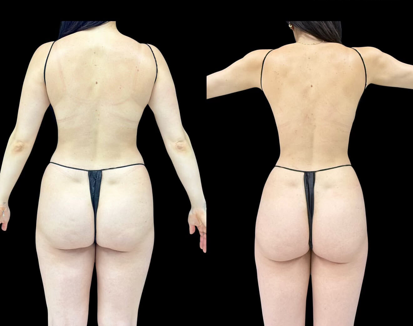 Awake liposuction results