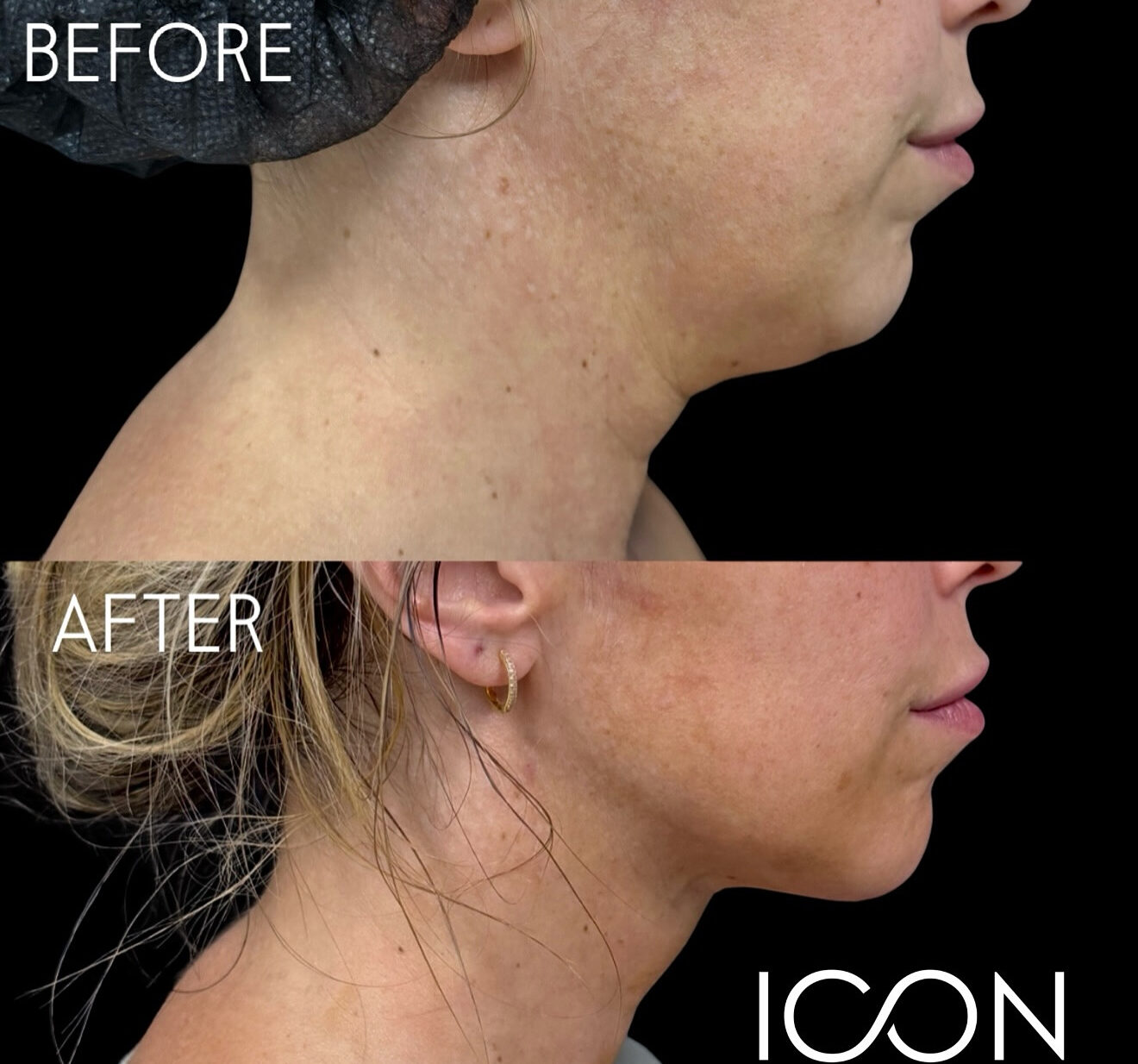 Awake liposuction procedure